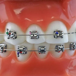 Brackets (vaste beugel)